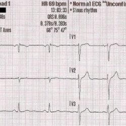 Wave ecg svg biphasic waves notched inverted ekg stepwards open designlooter upright normal atrial biology 2000px 42kb 2000 ecgs evaluating